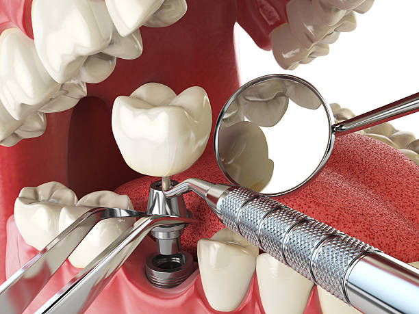 Best Emergency Tooth Extraction in Everett, WA
